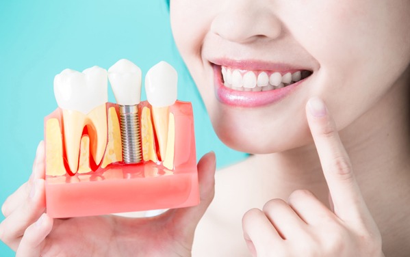 Dental Implants Have Long Been Used To Replace