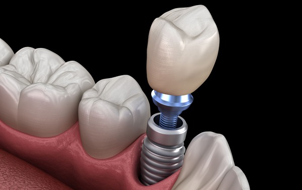 Dental Implants Specialist - Rosenthal Family Dentistry
