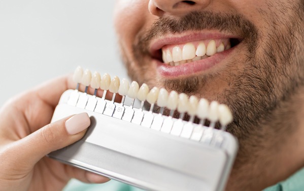 What Are Dental Veneers