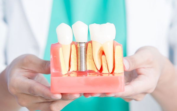 Dental Implants & Procedures - Rosenthal Family Dentistry