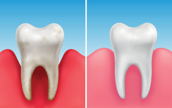 Periodontal Scaling and Root Planing - Rosenthal Family Dentistry