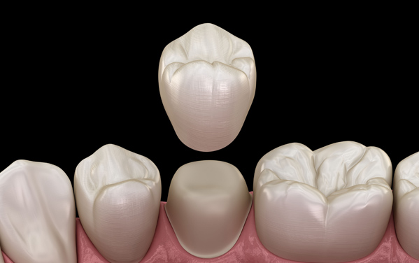 Dental Crowns - Rosenthal Family Dentistry