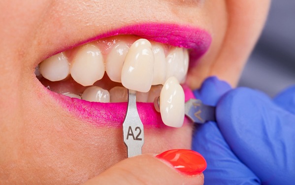 Why Would Dental Veneers Be Needed