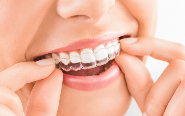 Why Would Invisalign Or Clear Aligners Be Needed