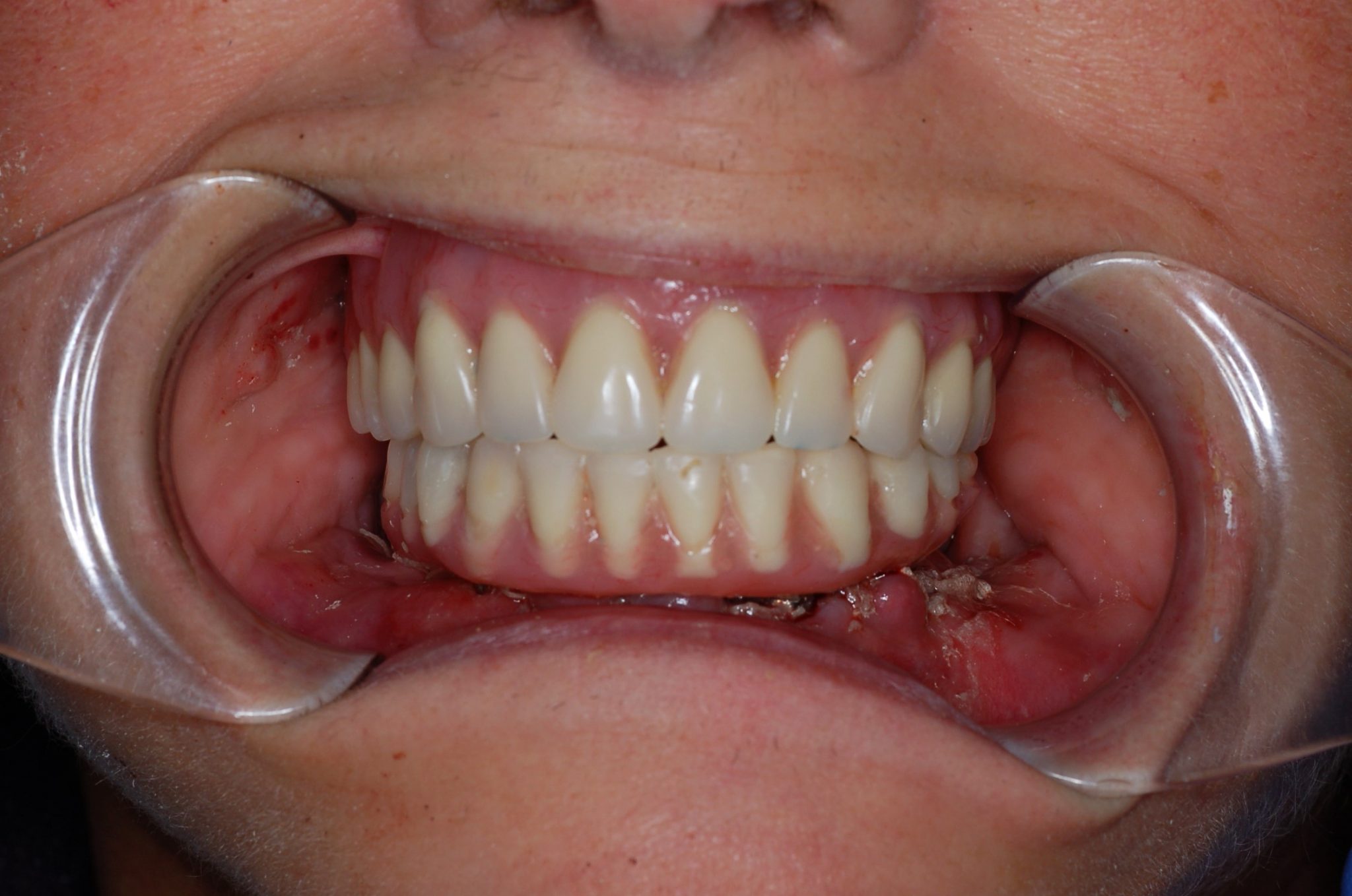 Hybrid Prostheses - Rosenthal Family Dentistry