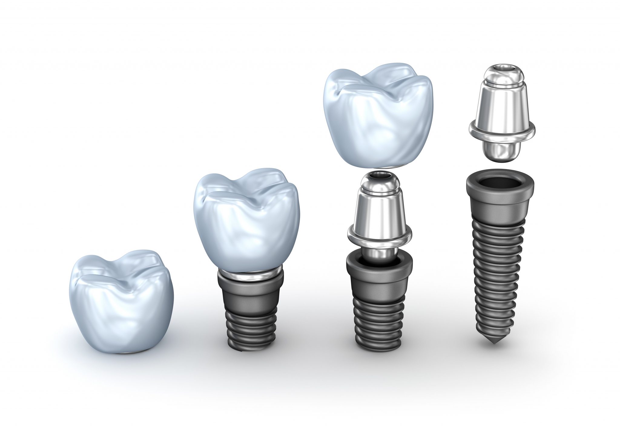 Dental Implants - Rosenthal Family Dentistry