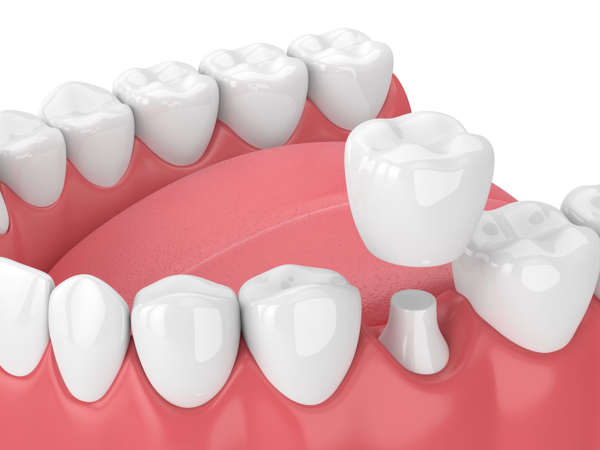 Dental Crowns - Rosenthal Family Dentistry