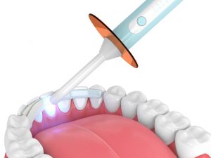 Dental Bonding - Rosenthal Family Dentistry