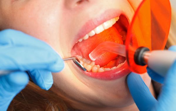 why would dental bonding be needed compressed
