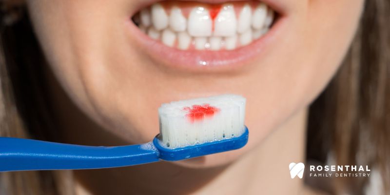 Prevention of Gum Disease