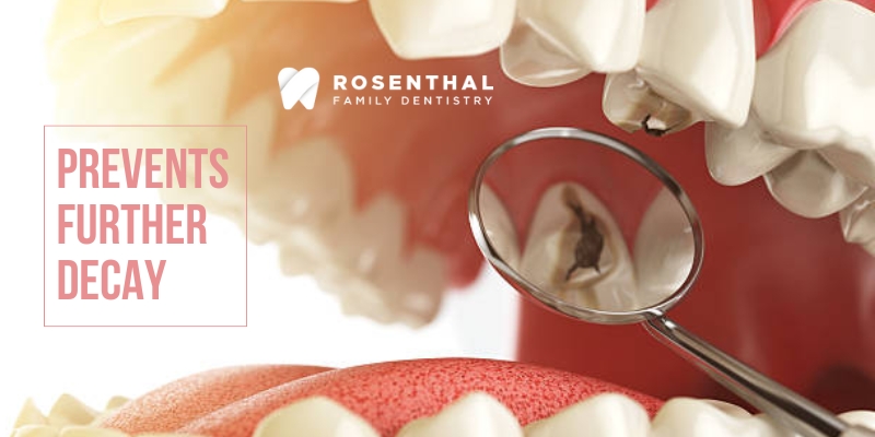 Tooth Decay - Rosenthal Dentistry