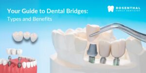 Different Types of Dental Bridges