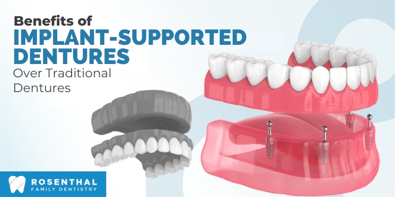 Implant Supported Dentures