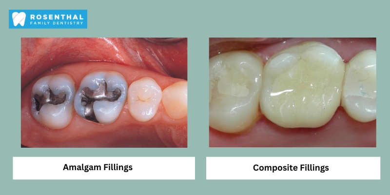 Types of Dental Fillings