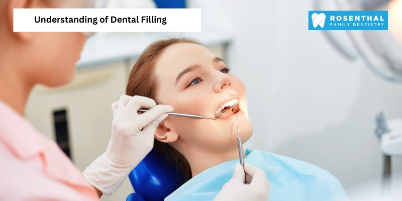 Types of Dental Fillings