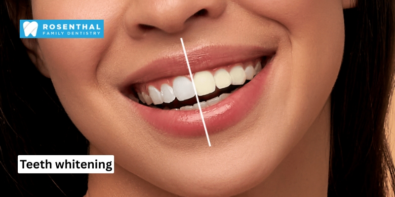 Teeth Whitening