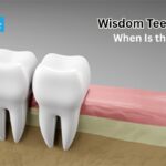 Wisdom Teeth Removal