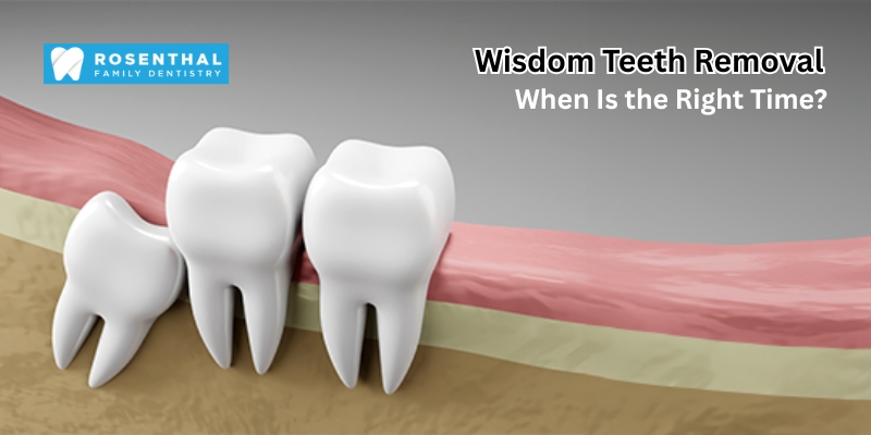 Wisdom Teeth Removal