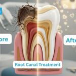 Root canal treatment