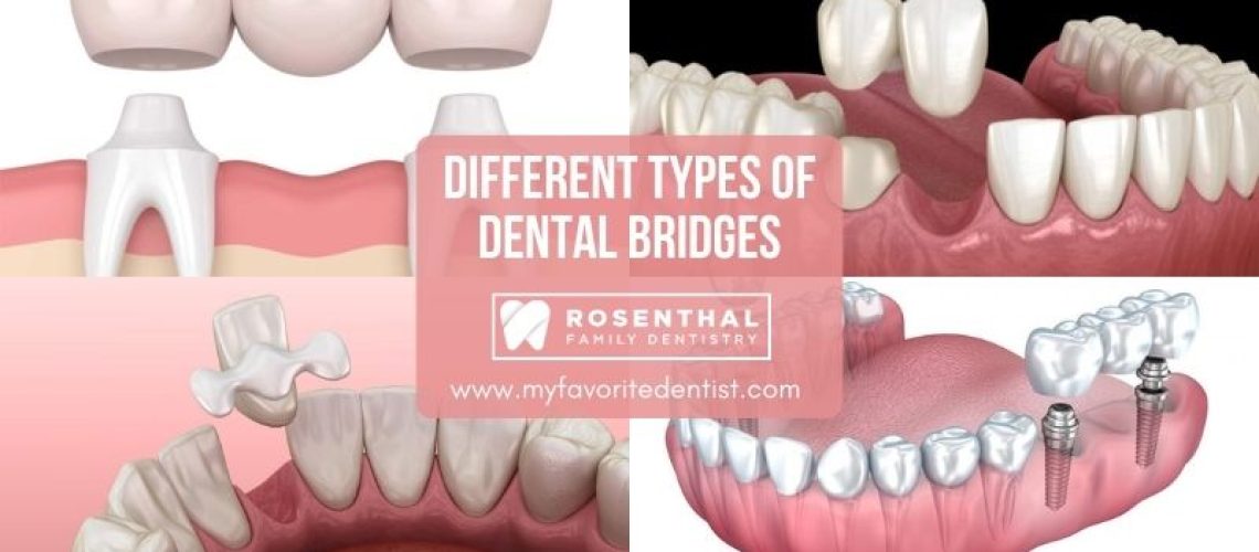 Different Types of Dental Bridges - Rosenthal family dentistry