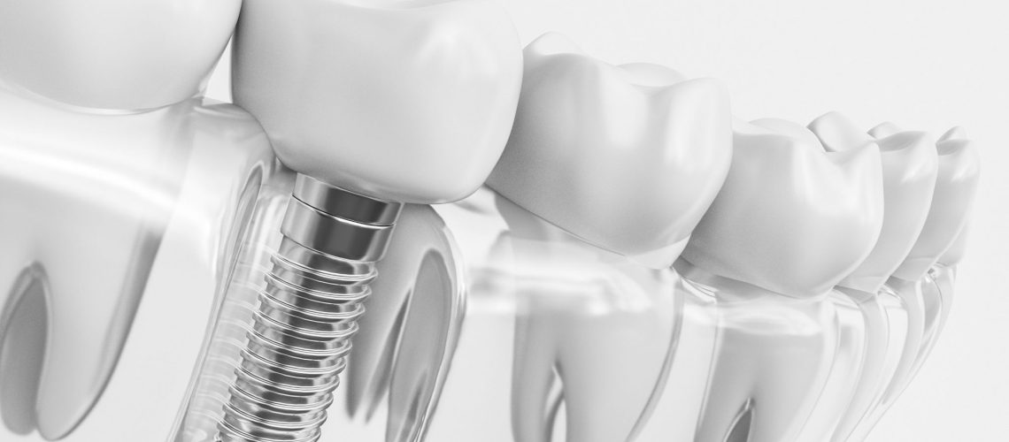 Dental Implants - Rosenthal Family Dentistry