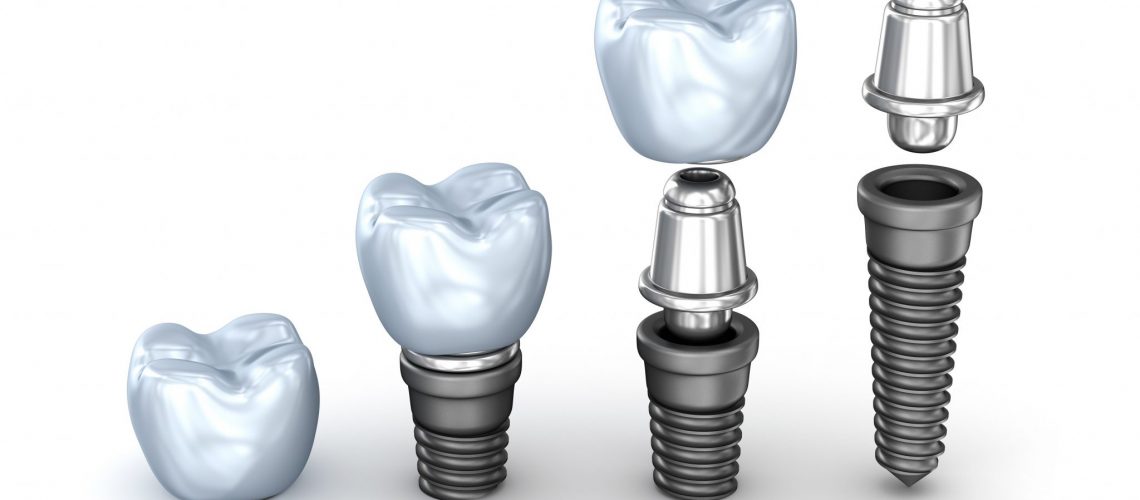 Feature Image 3 Dental Implants